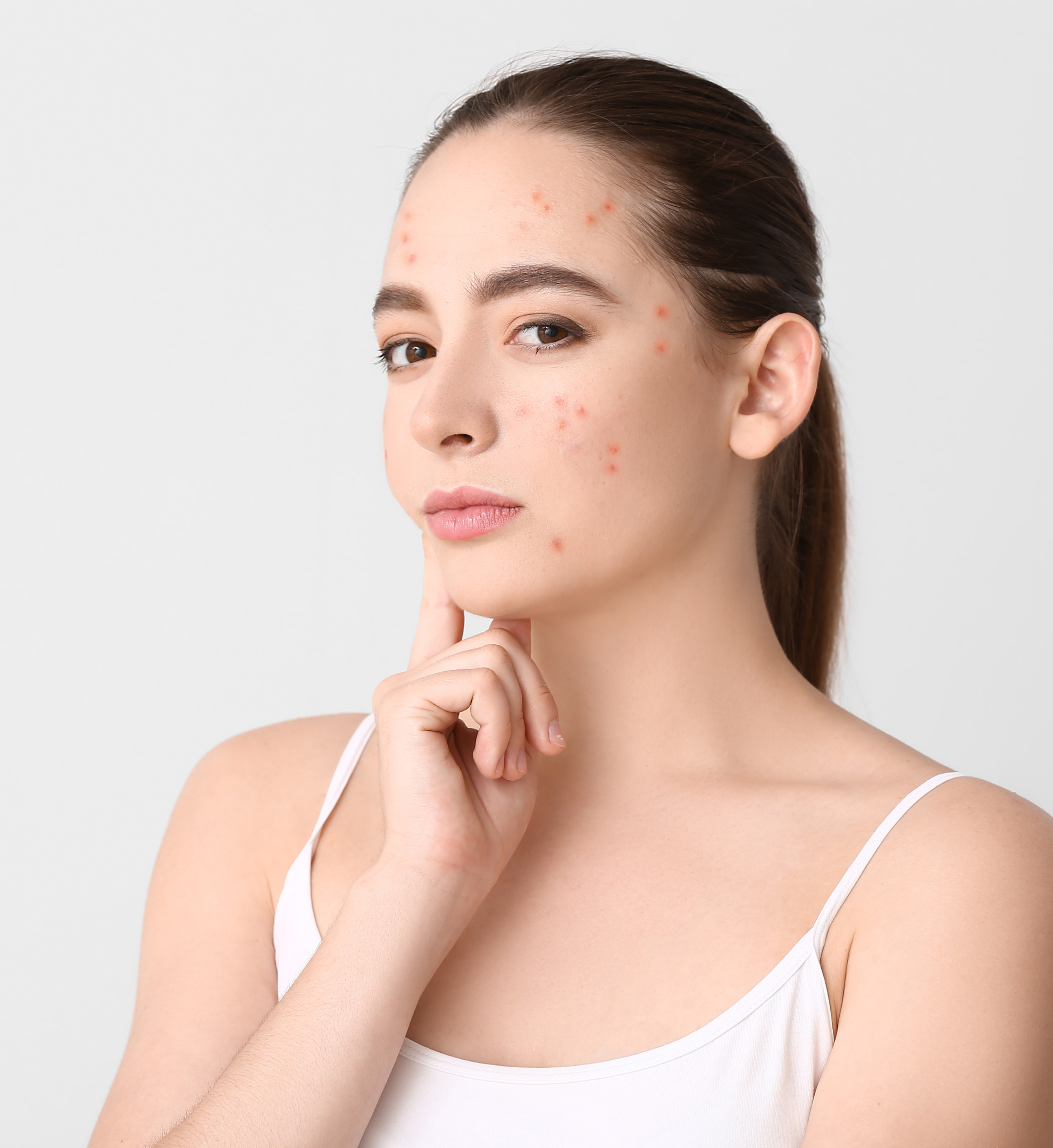 Acne cares