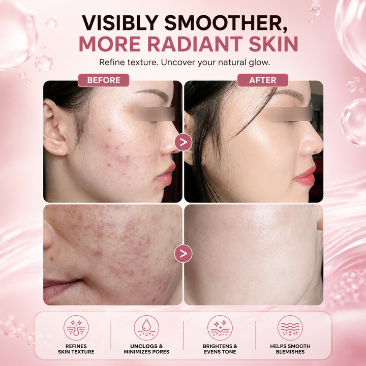 SANLIVNA AHA 30% BHA 2% Exfoliating Face Serum Salicylic Glycolic Acid 30ml